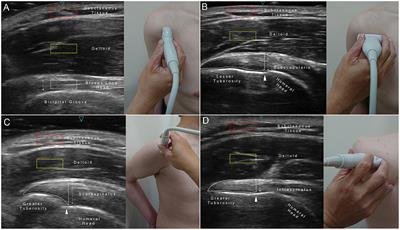 Sarcopenia Is Associated With Increased Risks of Rotator Cuff Tendon Diseases Among Community-Dwelling Elders: A Cross-Sectional Quantitative <mark class="highlighted">Ultrasound Study</mark>